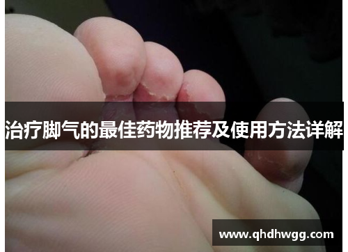 治疗脚气的最佳药物推荐及使用方法详解